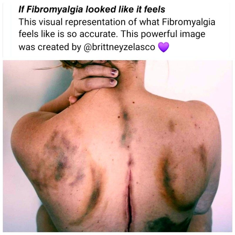 A View of a woman's back, it is bruised and cut and looks very painful. It illustrates how fibromyalgia feels.